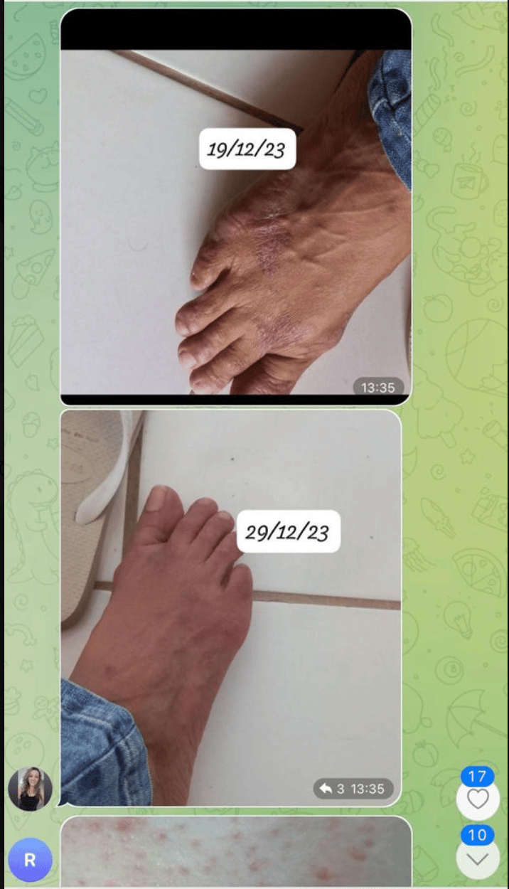 Depoimento real de aluno com antes e depois da psoríase 3