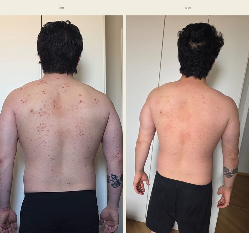 Depoimento real de aluno com antes e depois da psoríase 1