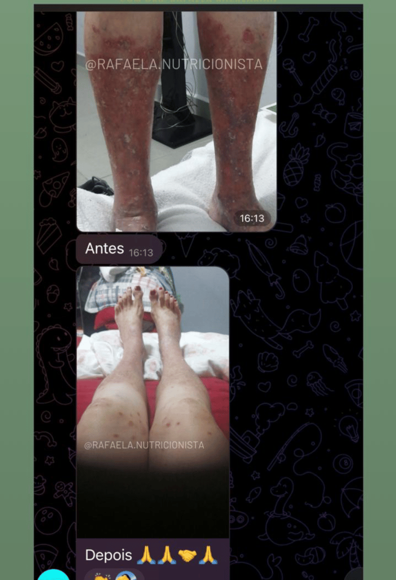 Depoimento real de aluno com antes e depois da psoríase 2