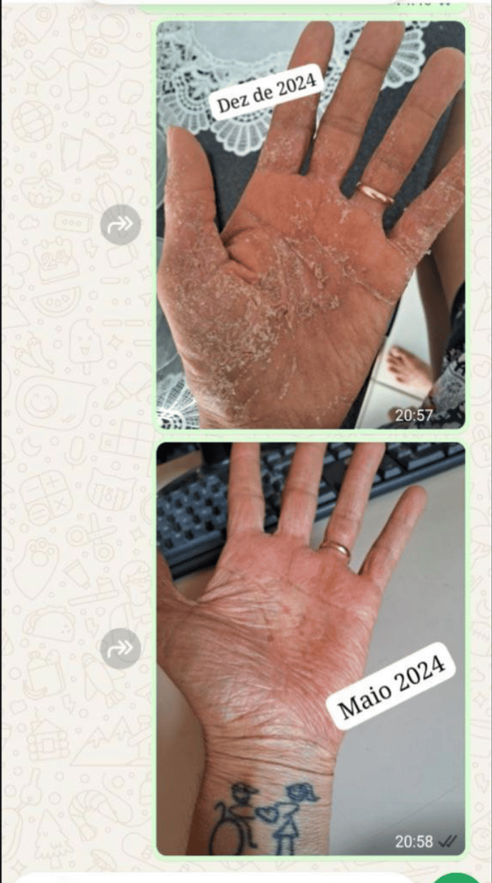 Depoimento real de aluno com antes e depois da psoríase 4